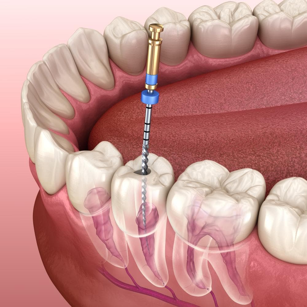 Root Canal Treatment: Timeframe, Procedure, and Recovery