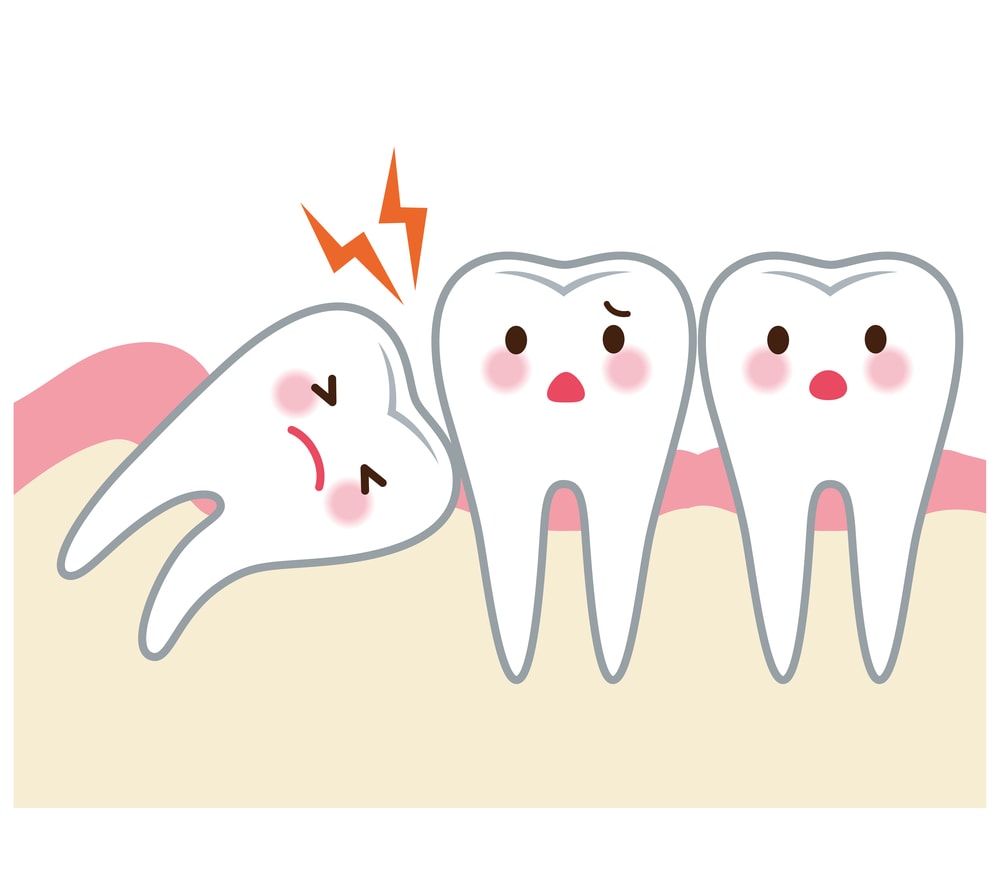 When Can You Brush Your Teeth After Wisdom Teeth Removal?